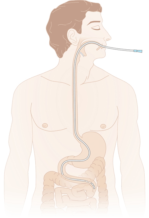 постановка дуоденального зонда