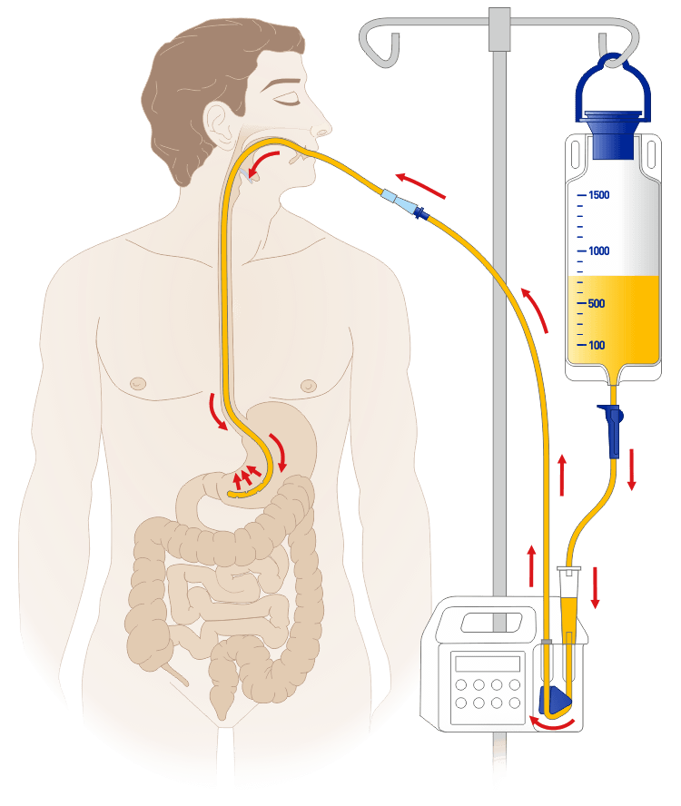 Схема постановки набора для введения энтерального питания MEDEREN