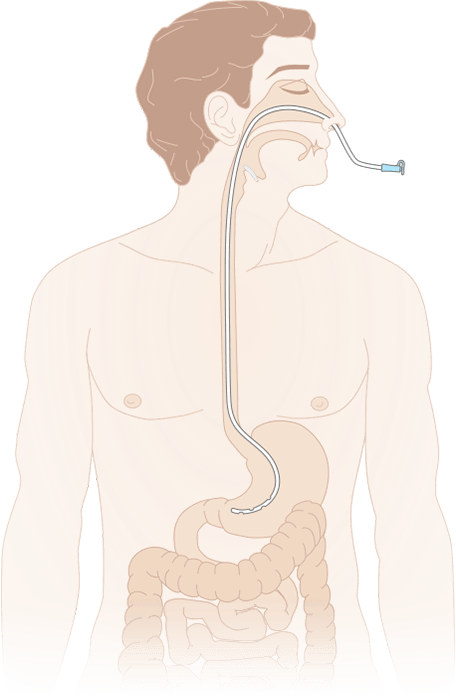 постановка питательного зонда