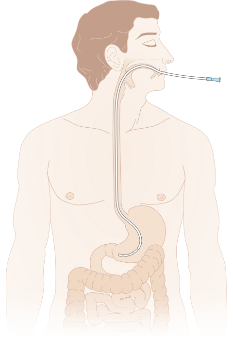постановка желудочного зонда