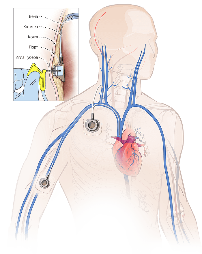 Имплантируемая порт-система и принцип их использования