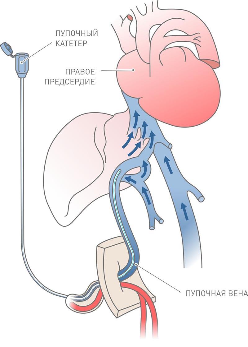 постановка пупочного катетера в пупочную вену
