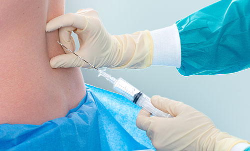 Схема постановки иглы для эпидуральной анестезии