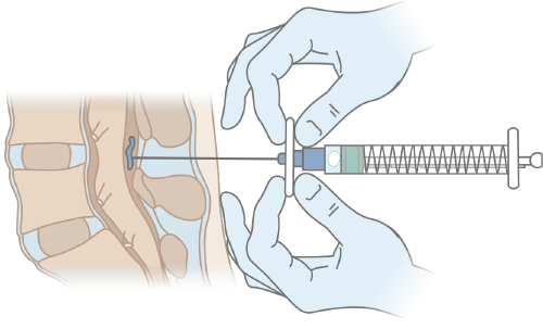 Схема постановки иглы для эпидуральной анестезии