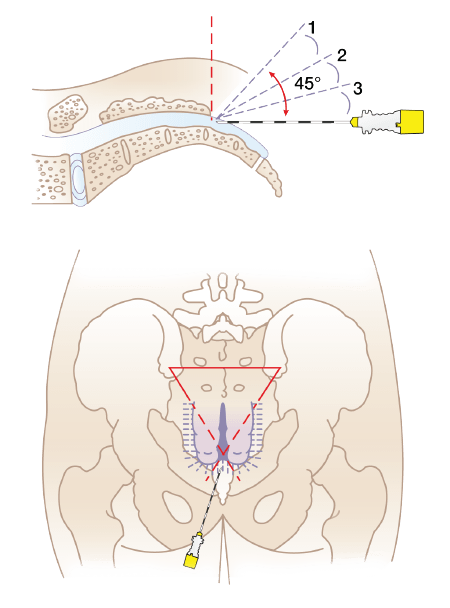 Схема постановки иглы для каудальной анестезии