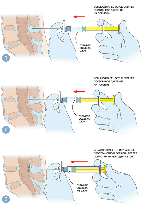 Идентификация эпидурального пространства методом потери сопротивления с ручным механическим шприцем MEDEREN