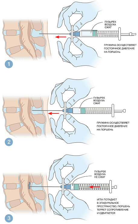 Идентификация эпидурального пространства методом потери сопротивления с автоматическим шприцем MEDEREN
