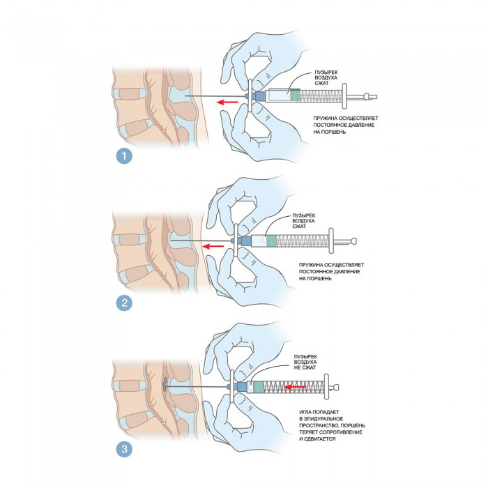 Идентификация эпидурального пространства
методом потери сопротивления с автоматическим шприцем MEDEREN