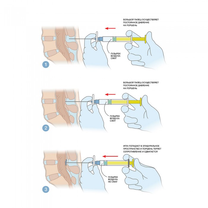 Идентификация эпидурального пространства
методом потери сопротивления с механическим шприцем MEDEREN