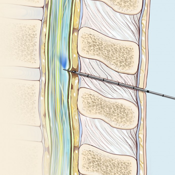 Пункция субарахноидального пространства с помощью
спинальной иглы и иглы Туохи с торцевым отверстием
