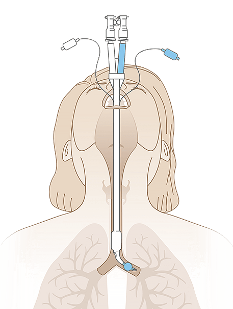 Схема интубации эндобронхиальной трубки MEDEREN