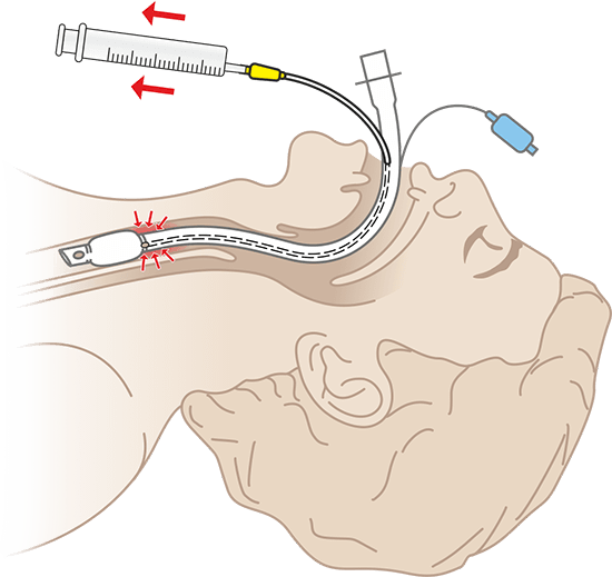  эндотрахеальные трубки с апирационным каналом (портом для санации), необходимым для санации надманжеточного пространства с целью снижения риска возникновения ИВЛ-ассоциированной пневмонии (VAP)