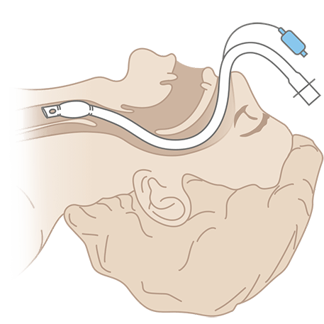 Схема интубации Полярной оральной эндотрахеальной трубки (южной)
