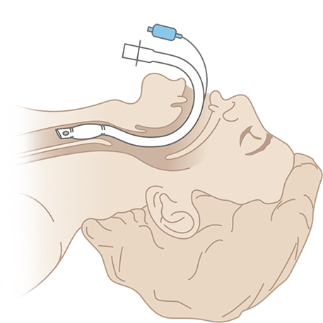Схема интубации Полярной оральной эндотрахеальной трубки (южной)