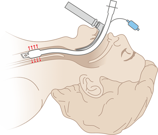 Схема интубации классической Эндотрахеальной трубки