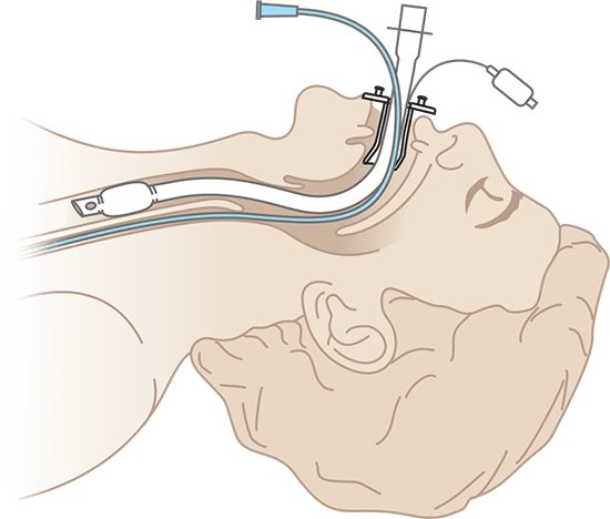 Схема фиксаторов для эндотрахеальных турбок