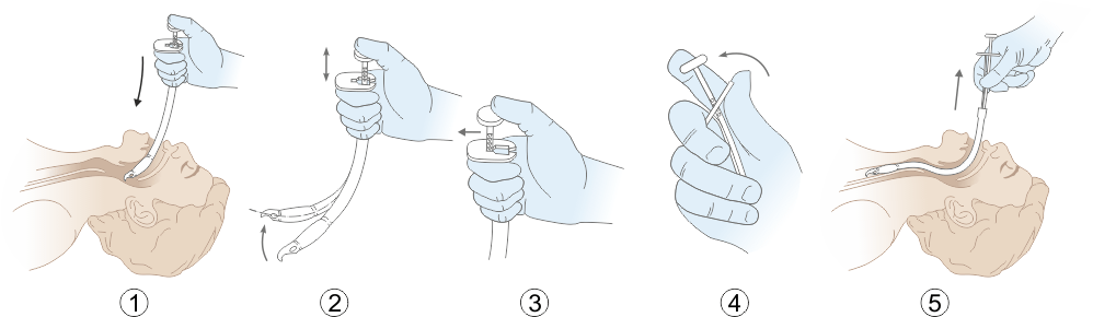 Порядок использования стилета Паркер
