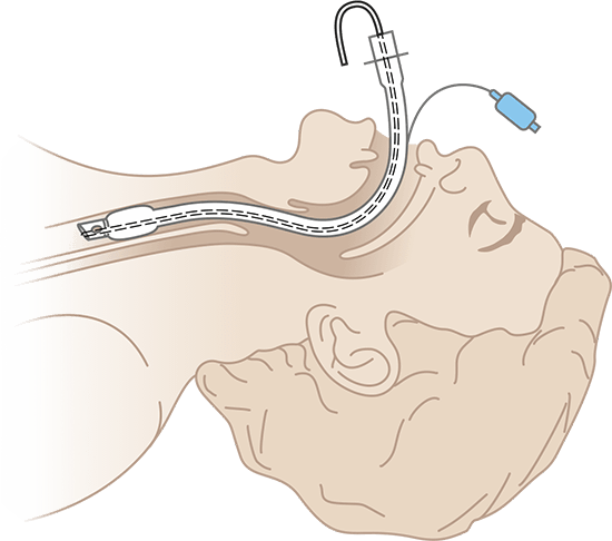 Схема интубации эндотрахеальной трубки со стилетом