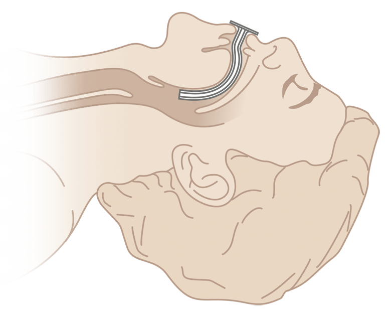 Схема постановки воздуховода Бермана
