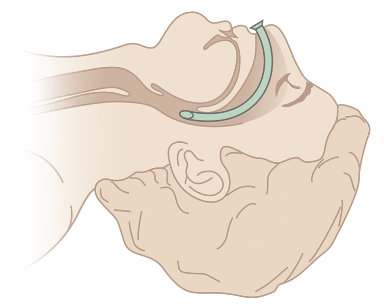 Схема постановки воздуховода Бермана