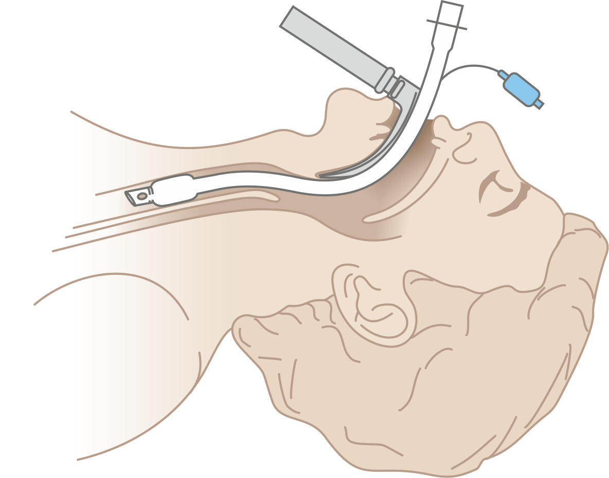 Схема использования клинков для Ларингоскопа