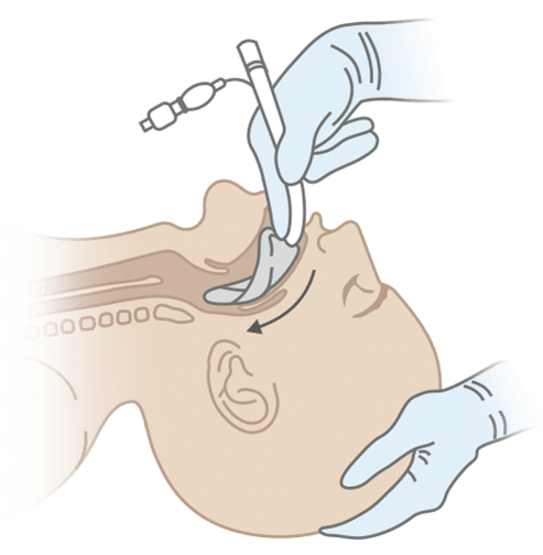 Схема постановки ларингеальной маски ПВХ