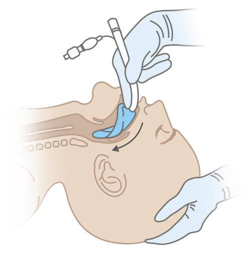 Схема постановки силиконовой ларингеальной маски 