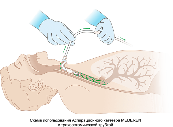 Схема использования Аспирационного катетера MEDEREN с эндотрахеальной трубкой