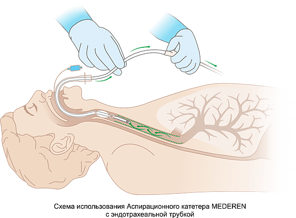 Схема использования Аспирационного катетера MEDEREN с трахеостомической трубкой