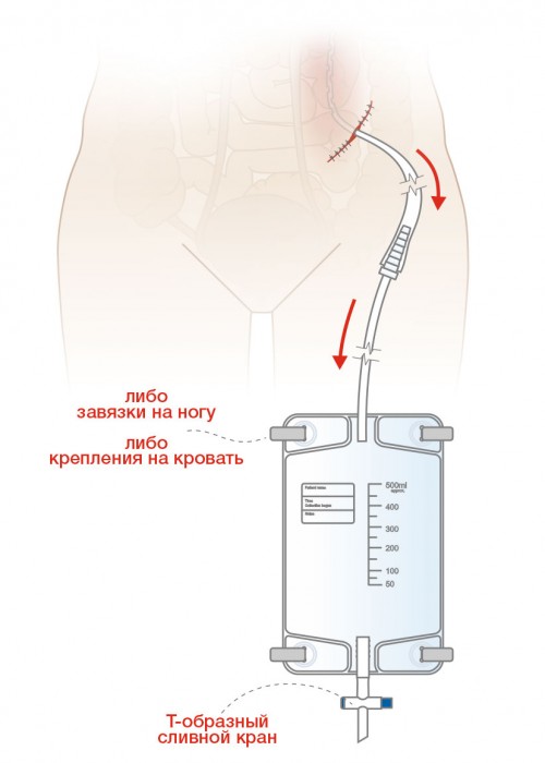 Схема использоваия ПВХ-мешков для дренирования MEDEREN
