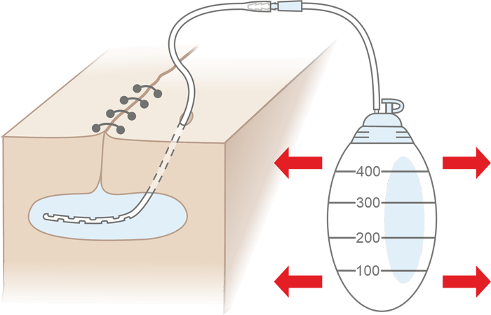 Схема использоваия ПВХ-мешков для дренирования MEDEREN