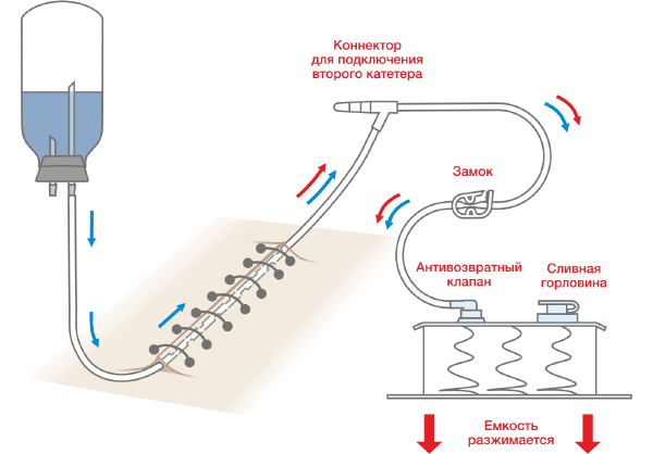 Схема работы набора с дренажным резервуаром с системой пружин