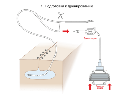 Схема постановки дренажной трубки Редона