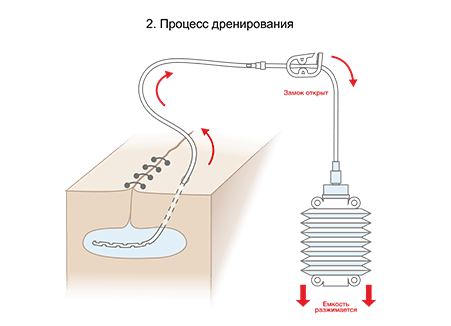 Схема работы дренажа Редона