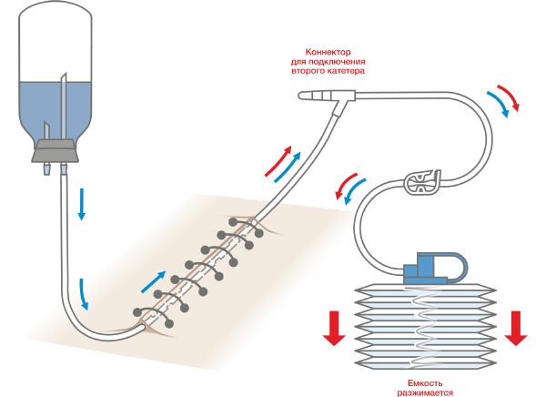 Схема постановки дренажной трубки Редона