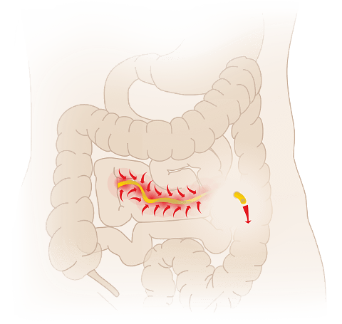 Схема постановки дренажной трубки Пенроуз