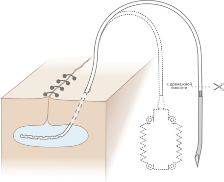 Схема постановки дренажной медицинской трубки