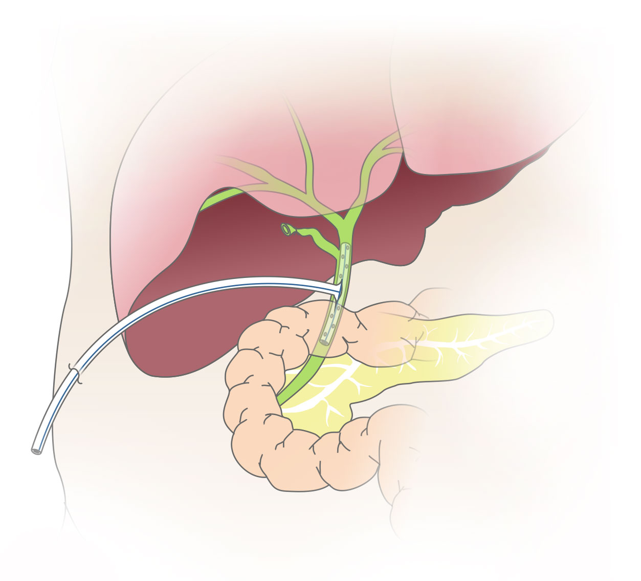 Схема дренирования желчных путей трубки Кера