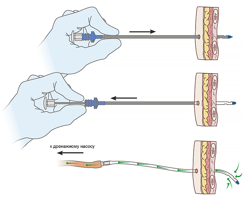 Схема постановки тарокального троакара Volkmann