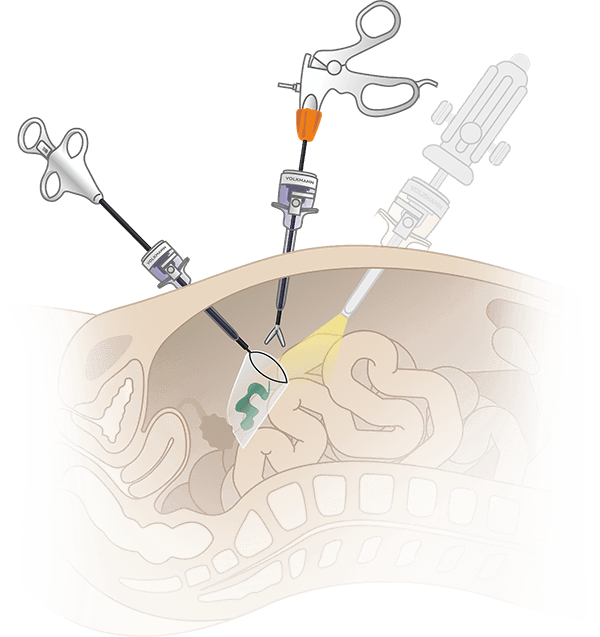 Схема использования сачков лапароскопических для извленения органов производства Volkmann