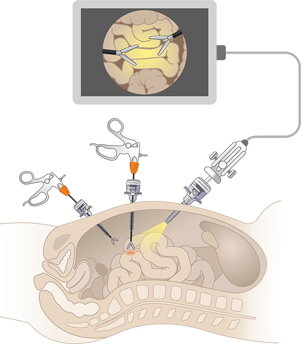 Принцип использования инструментов в малоинвазивной хирургии