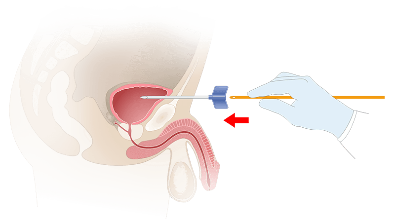 Схема проведения надлобковой пункции для дренирования мочевого пузыря