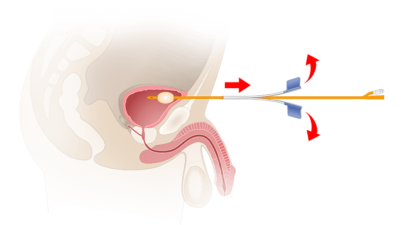 Схема удаления троакар-канюли