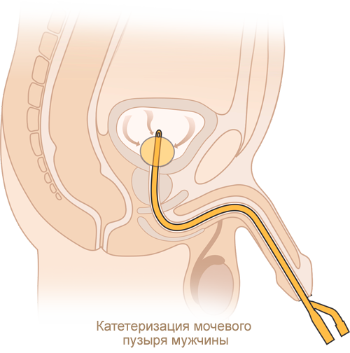 Катетеризация мочевого пузыря мужчины катетером Фолея MEDEREN