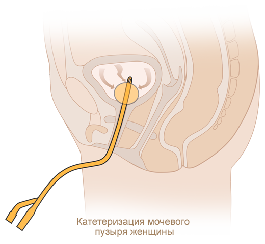 Катетеризация мочевого пузыря женщины катетером Фолея MEDEREN