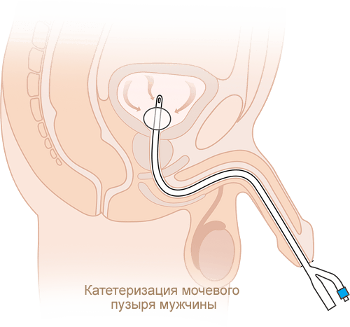 Катетеризация мочевого пузыря мужчины силиконизированным катетером Фолея
