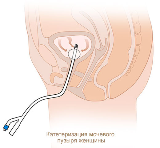Катетеризация мочевого пузыря женщины катетером Фолея MEDEREN