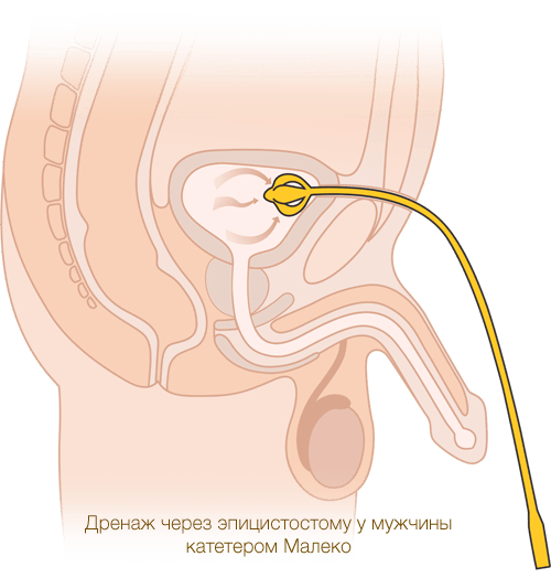 схема дренажа эпицистостомы у мужчины катетером Малеко производства MEDEREN