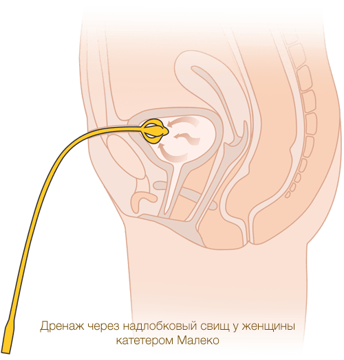Катетеризация надлобкового свища у женщины катетером Малеко производства MEDEREN