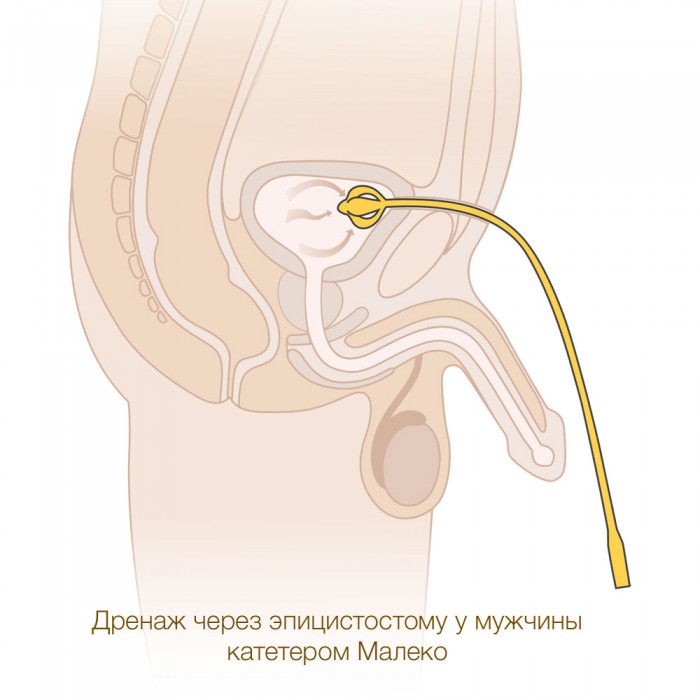 Дренаж через эпицистостому у мужчины
катетером Малеко MEDEREN